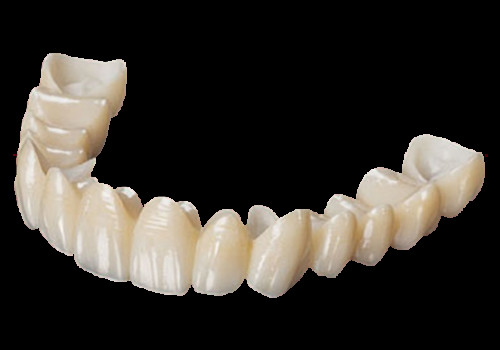 Alta estetica, corona di zirconia a contorno completo