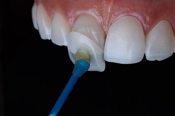Permanente Composito Emax Zirconia Laminato Finiture dentali naturale aspetto