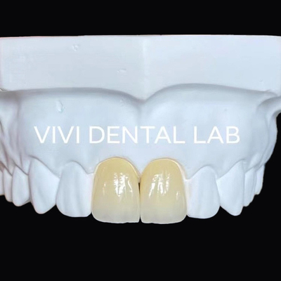 Impianto dentale a mascella piena Ponte di zirconia Corona traslucidità Estetica