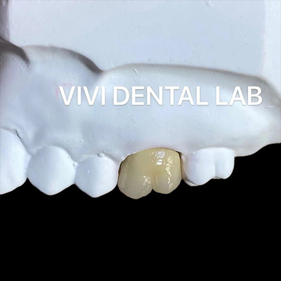 Be Ni Free Metal Porcellana Corona PFM Corona Cina Dental Lab