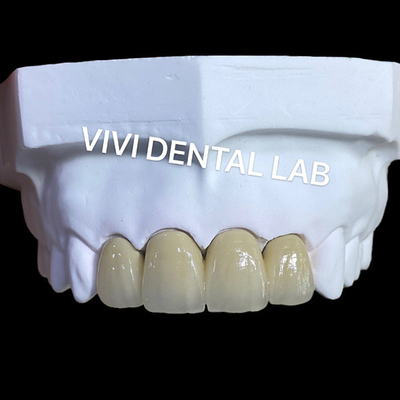 PFM Corone di laboratorio dentale SLM Tecnica con Scheftner 30 in polvere di lega