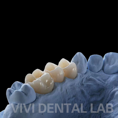 Corone di laboratorio dentale a contorno completo di alta traslucidità