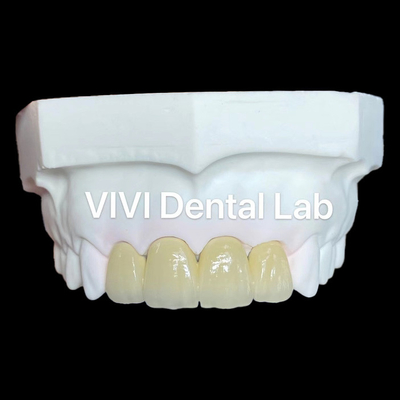 Coroe di zirconio PFZ Coroe di zirconio di porcellana Coroe dentali