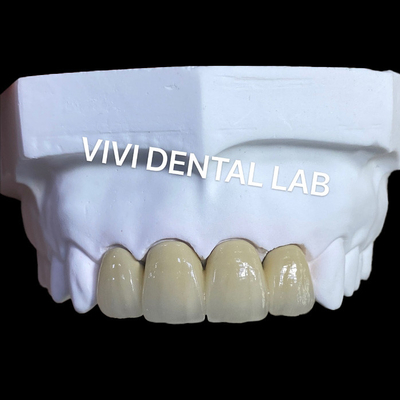 Corona metallica ceramica PFM Corona e ponte dal laboratorio dentale cinese