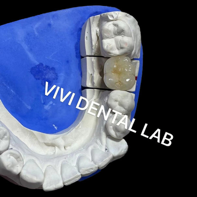 Ivoclar Scheftner Corone metalliche di porcellana Corone metalliche di ceramica