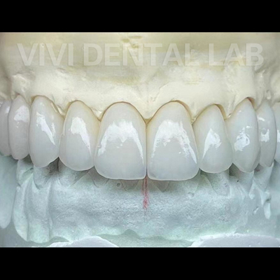 Laboratorio dentale Coroe e ponti in zirconia