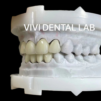 Corona e ponte di zirconia a strati forti in buona estetica
