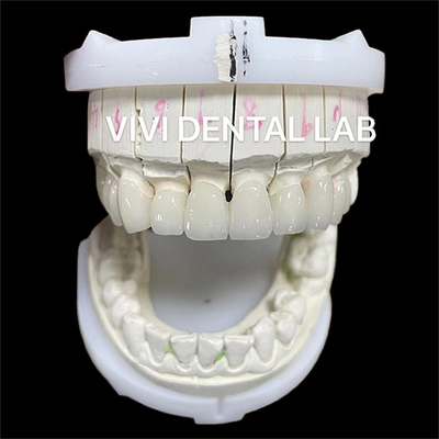 Alta estetica Zirconia corone di laboratorio dentale ponte con porcellana stratificata