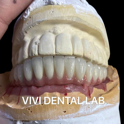 Implantazione dentale Ponte in metallo ceramica su supporti in titanio