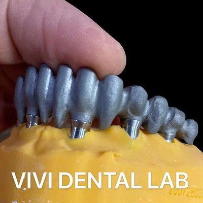 Ponte stampata PFM su abutmenti multi-unità dal laboratorio dentale cinese