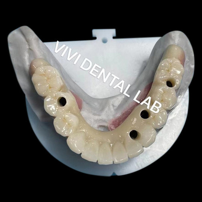 Ponte a vite di zirconia a più strati biocompatibile su struttura metallica
