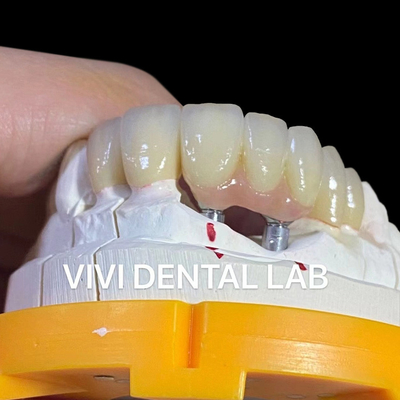 Porcellana Zirconia Dental Implant Bridge Professionale Alta Estetica