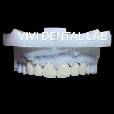 Dental Anterior Zirconia Bridge ISO Certified Fast Turnaround Time (Tempo di risposta veloce certificato ISO)