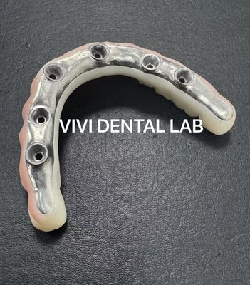 Ponte estetica di zirconio completo con barra di titanio avvitata trattenuta dal laboratorio dentale cinese