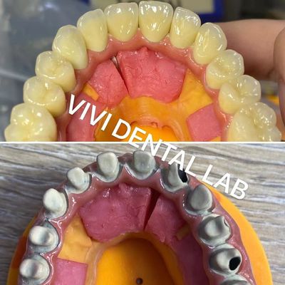 Ivoclar Digital Dental Crowns Process Noritake Porcellana Alta precisione