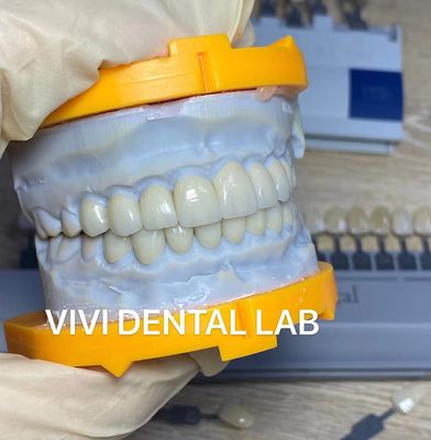 L'alto laminato estetico di Emax dei denti impiallaccia il laboratorio dentario della Cina della traslucidità Incisal