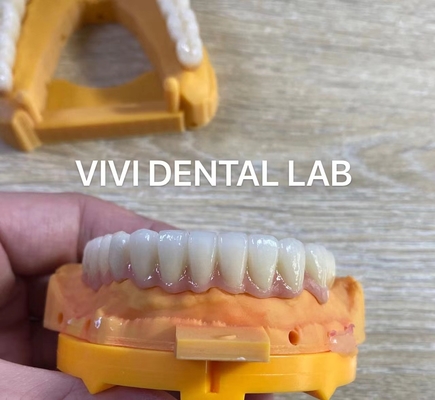 Impianto dentale a mascella piena Ponte di zirconia Corona traslucidità Estetica