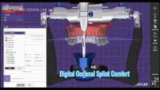Stecca occlusale digitale Comfort accurato