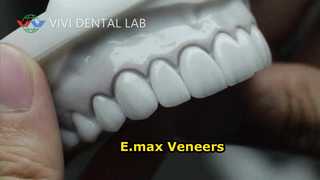 Laminati per faccette dentali