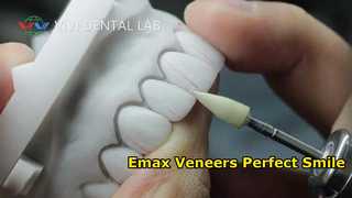 Veneer Emax